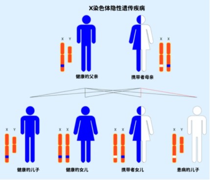 杜氏肌肉萎缩