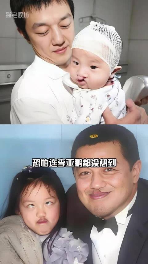 王菲二女儿经历四次手术成功矫正兔唇