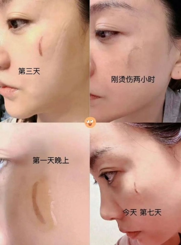 杨蓉右脸烫伤后主动晒“疤”：晒出无滤镜素颜恢复照并配文“带疤的脸很酷”